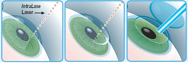 Bladeless LASIK Laser Technology 