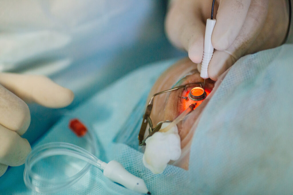 Is Cataract Eye Surgery Right for You? Signs It’s Time to Consider Treatment